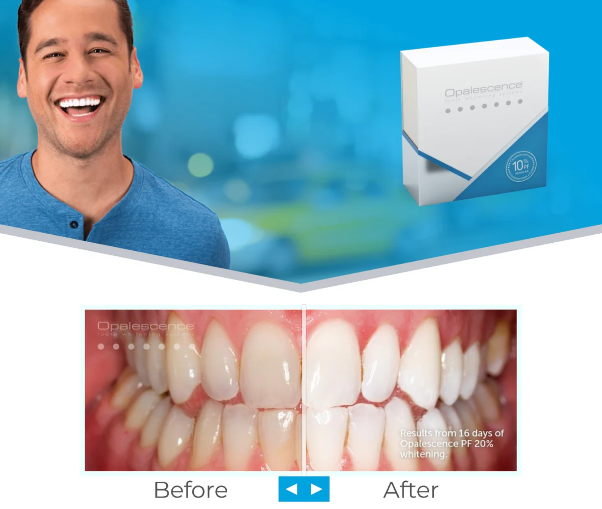 Opalescent 牙齒美白凝膠